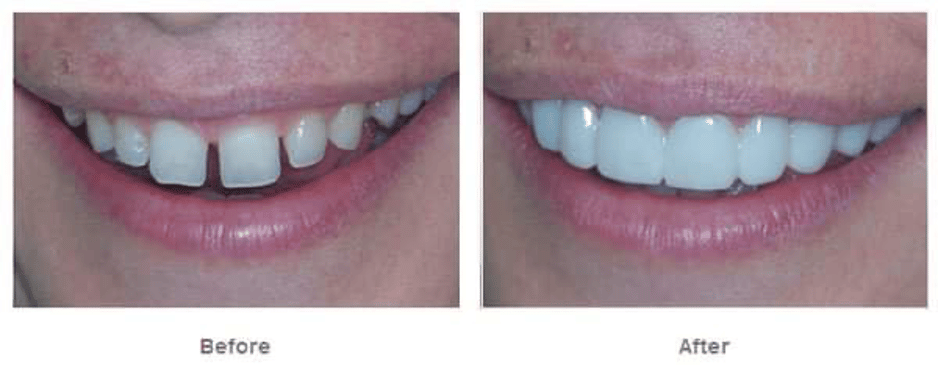 odontoiatria estetica snap on smile